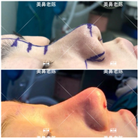 上海耳软骨隆鼻医生