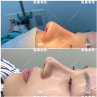 陈坚肋骨鼻整形