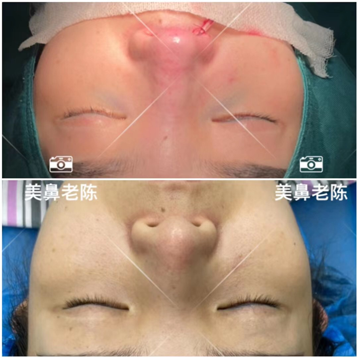 上海鼻王整形医生陈坚