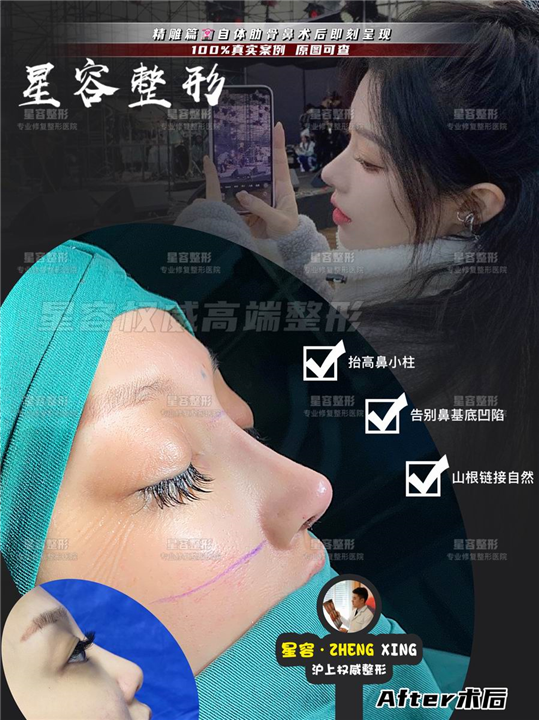 鼻综合都包括什么项目?