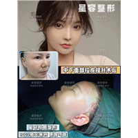 上海WJ做拉皮多少钱