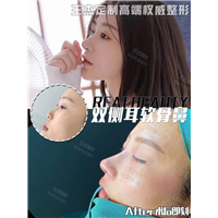 双侧耳软骨鼻综合