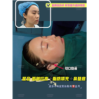 拉皮手术真的那么可怕吗？