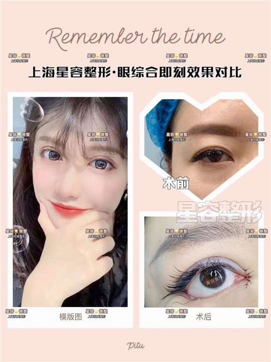 做双眼皮应该注意什么
