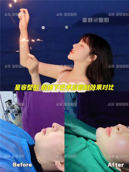 做假体垫下巴术后会移位吗？
