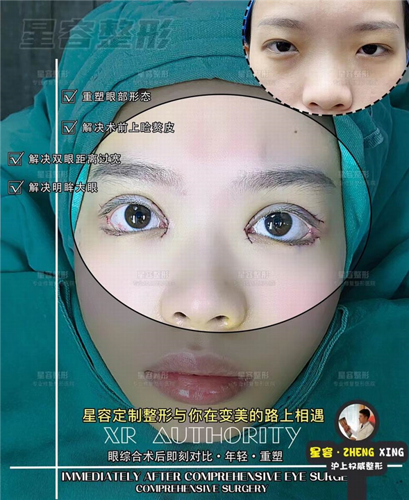 开眼角手术的7大注意事项
