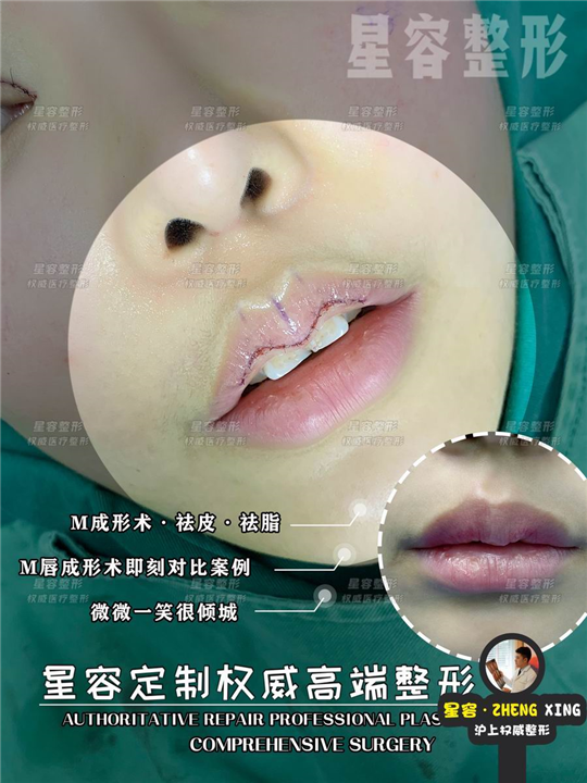 哪些人适合做 M 唇手术？