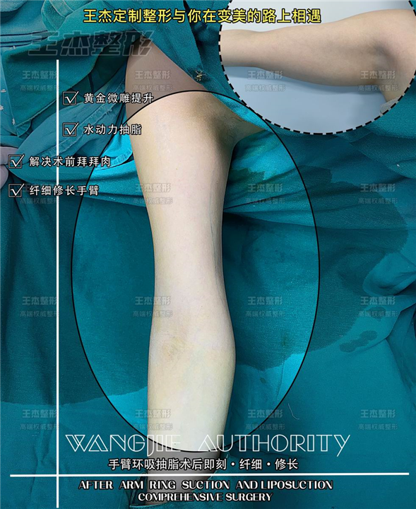 WJ整形科普：为什么手臂吸脂后感觉更粗了？