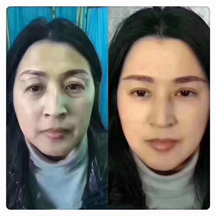 拉皮手术会损失面部表情吗？
