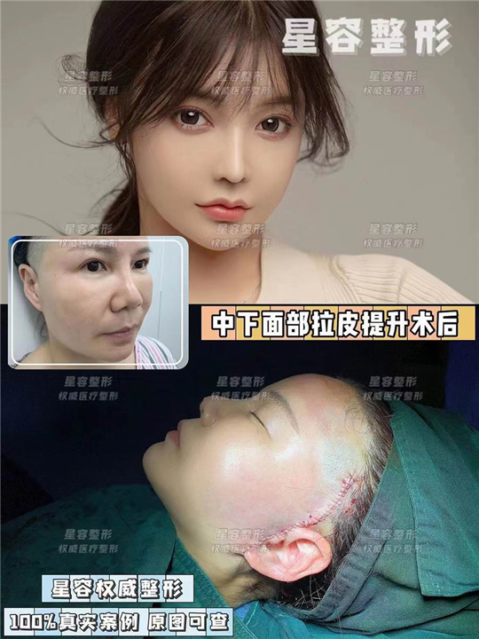 上海WJ做拉皮多少钱