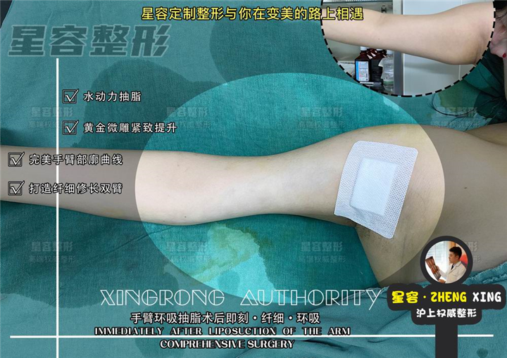 上海WJ整形手臂吸脂恢复期