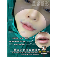 微笑唇价格