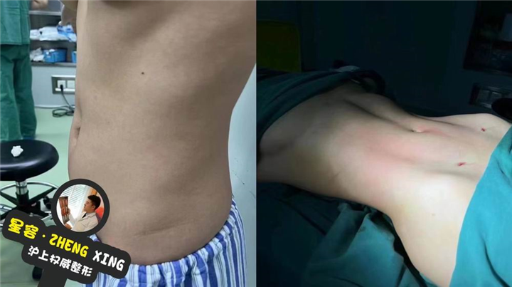 上海腰腹吸脂多少钱