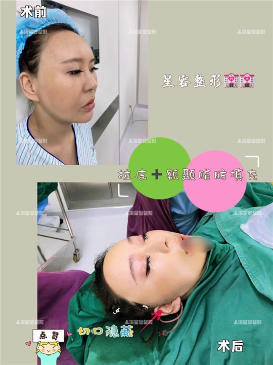 小切口拉皮手术不是一生只能做一次
