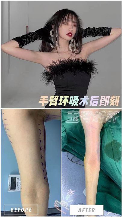 做手臂吸脂的注意事项有啥？有哪些特点？