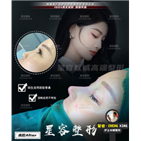 做全肋骨鼻效果怎么样？之后会不会容易变形？