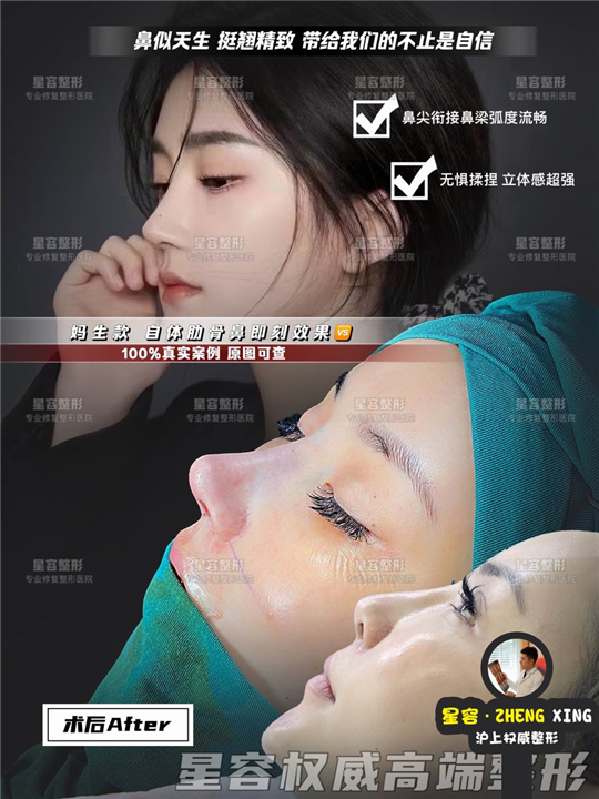 肋骨鼻没做好，之后修复还需要取肋软吗？