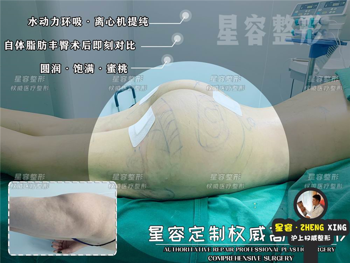 臀部吸脂方式