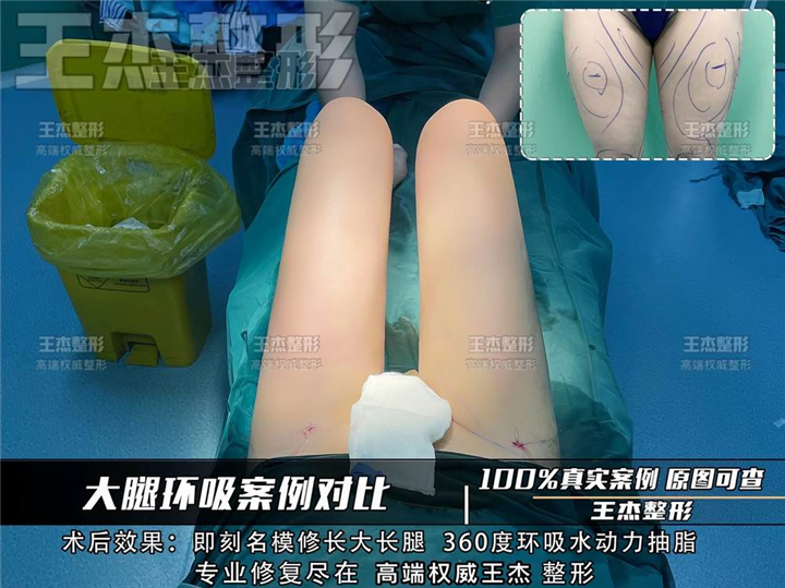 腿部吸脂的三点原则你都了解吗？