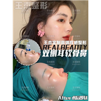 鼻部整形包含哪些项目？
