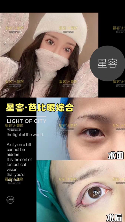 双眼皮术后多久可以化眼妆？