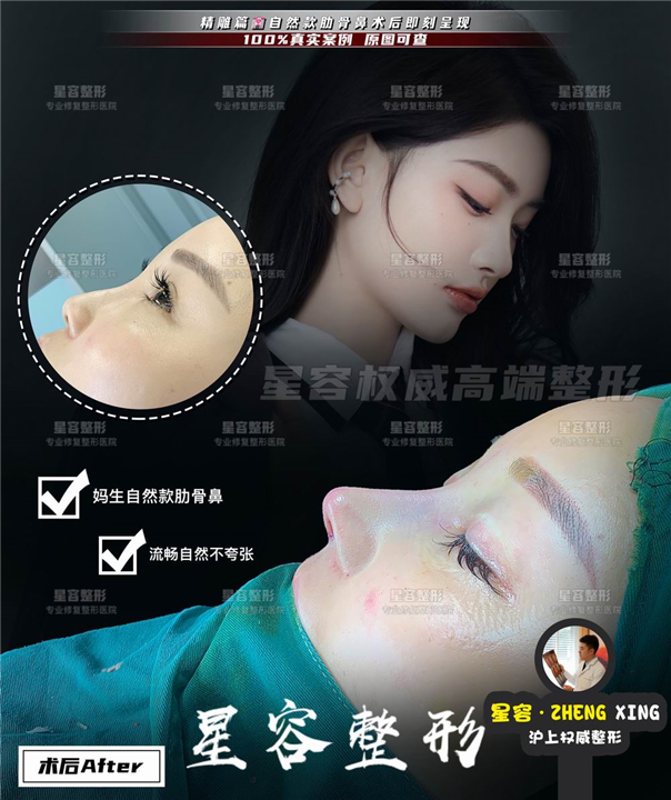 做全肋骨鼻效果怎么样？之后会不会容易变形？