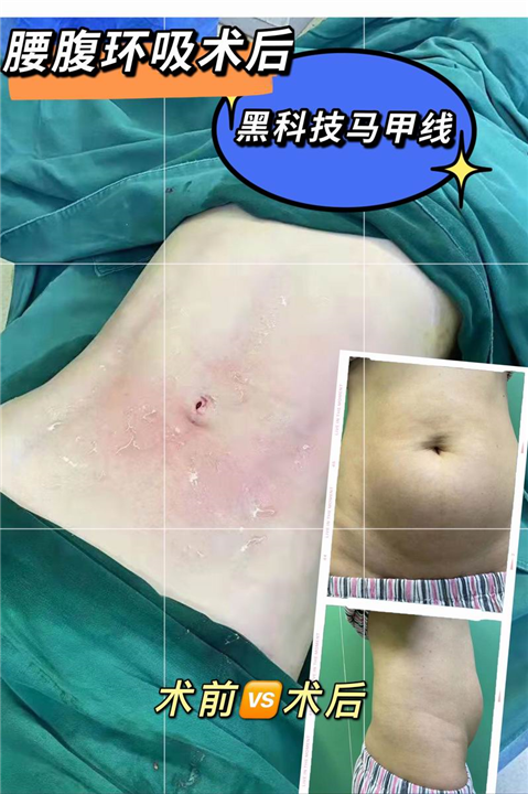 腰腹吸脂消肿一般要多久?
