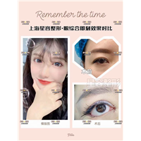 做双眼皮应该注意什么