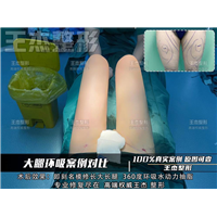 腿部吸脂的三点原则你都了解吗？