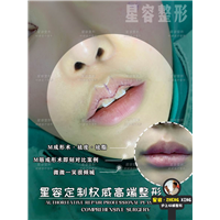 哪些人适合做 M 唇手术？