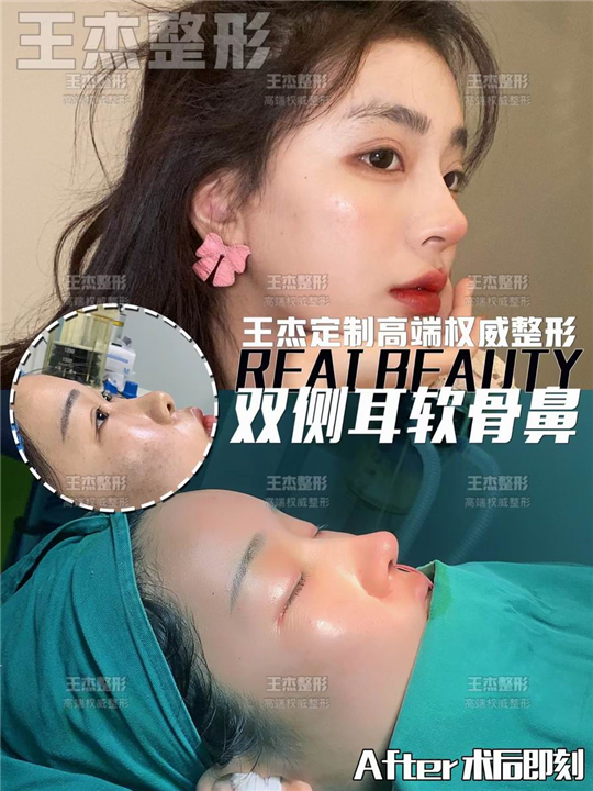 鼻部整形包含哪些项目？