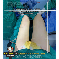 大腿吸脂常见的几种副作用