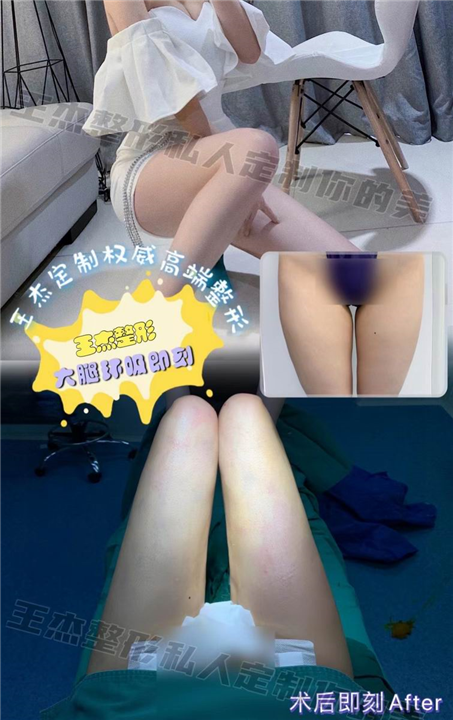 大腿吸脂五大副作用