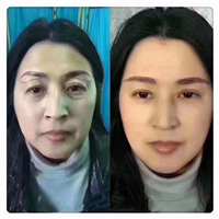 拉皮手术会损失面部表情吗？