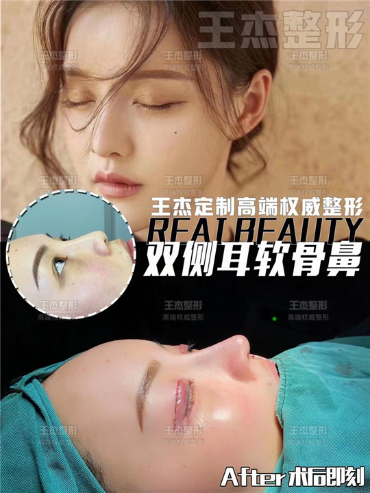 双侧耳软骨垫鼻尖