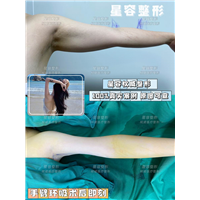 担心手臂吸脂会有副作用？留意这些注意事项……