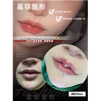 上唇综合（厚唇改薄＋ m 唇成型术）