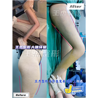 上海大腿吸脂后恢复时间