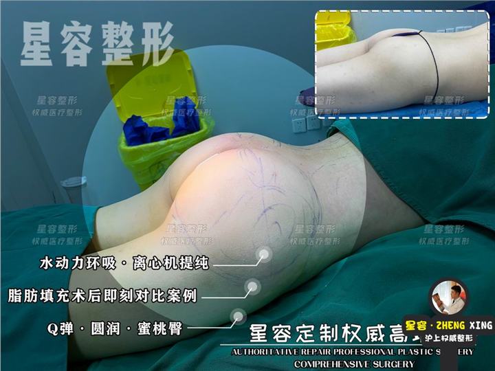自体丰臀的优缺点？