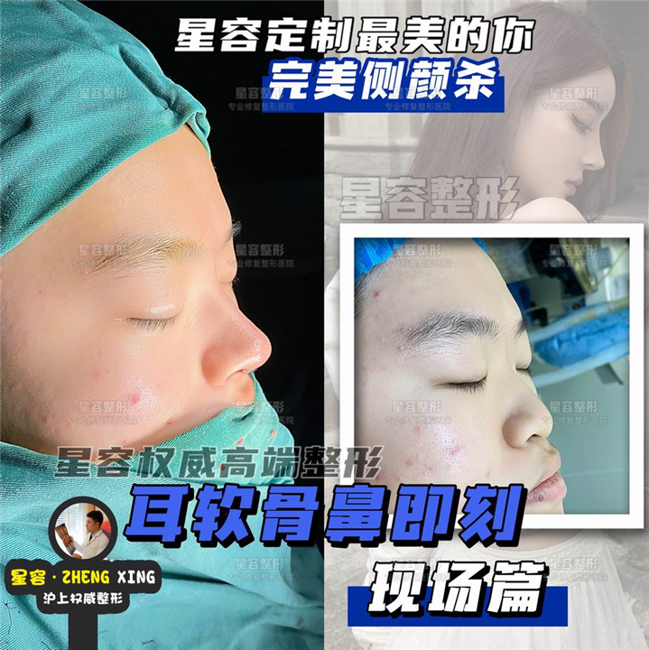 上海WJ做耳软骨隆鼻多少钱