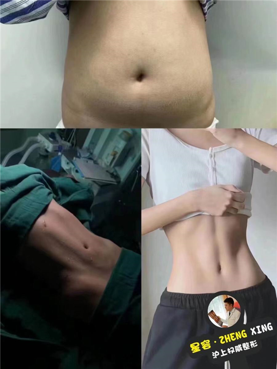 腰腹吸脂和腹壁整形分别适用于哪些群体？