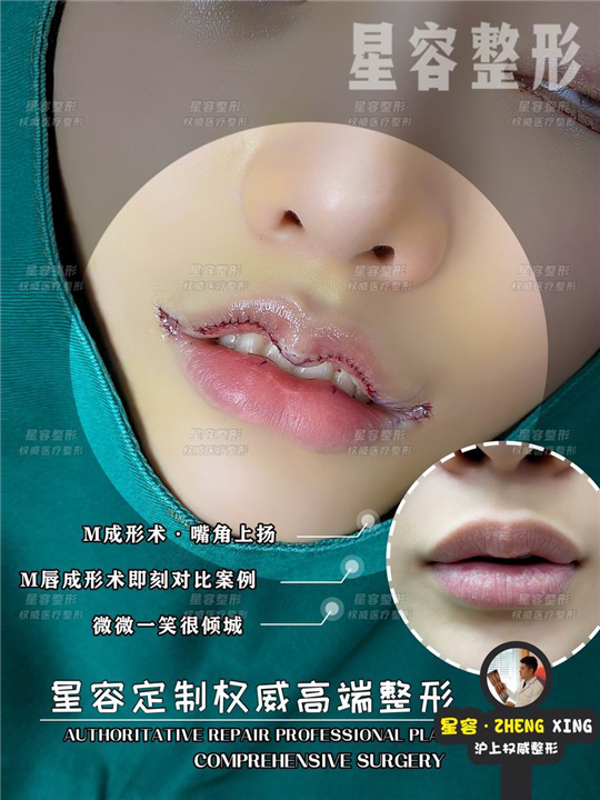 微笑唇价格
