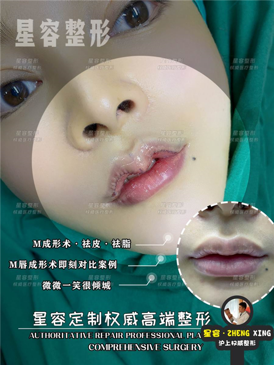M唇整形价格