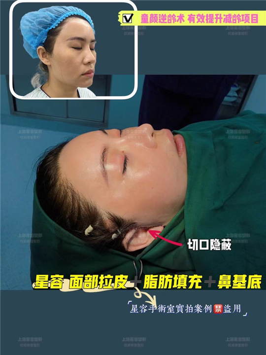 拉皮手术真的那么可怕吗？
