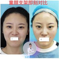 童颜支架提升术