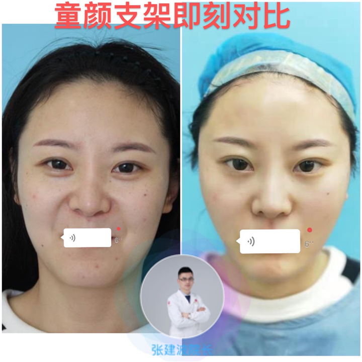 童颜支架提升术