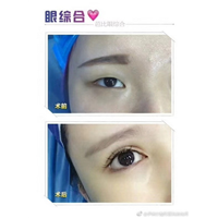 西安双眼皮整形医院 