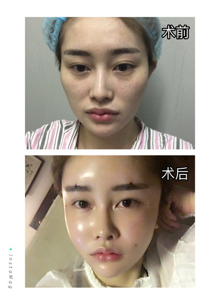 西安脂肪填充整形 