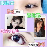 西安欧式混血眼综合 