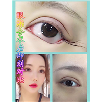 西安眼综合整形 